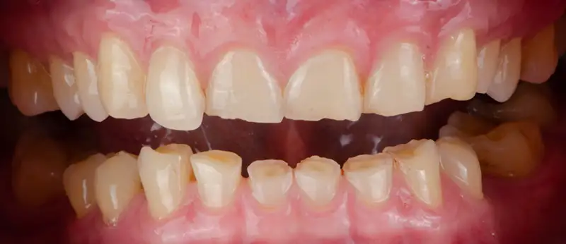 Bruxismus (Zähneknirschen): Abrieb Zähne