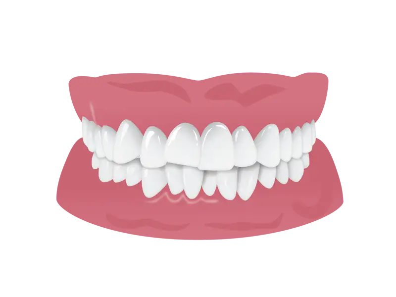 Engstand der Zähne