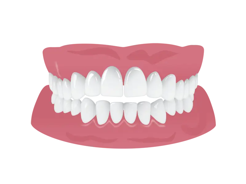 Engstand der Zähne