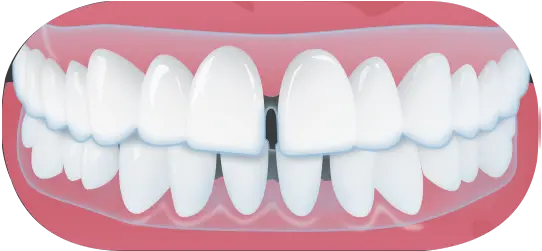 Zahnkorrektur: Behandlung mit Alignern