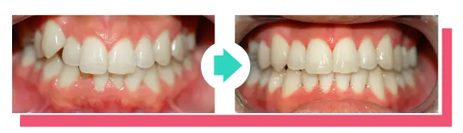 Ergebnis Zahnkorrektur: Schiefe Zähne