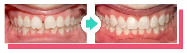 Ergebnis Zahnkorrektur: Zahnlücken