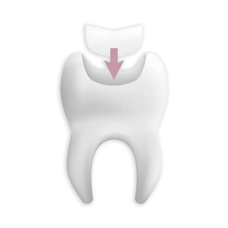 Icon Füllungstherapie: Zahnarztpraxis DENTAL CORNER